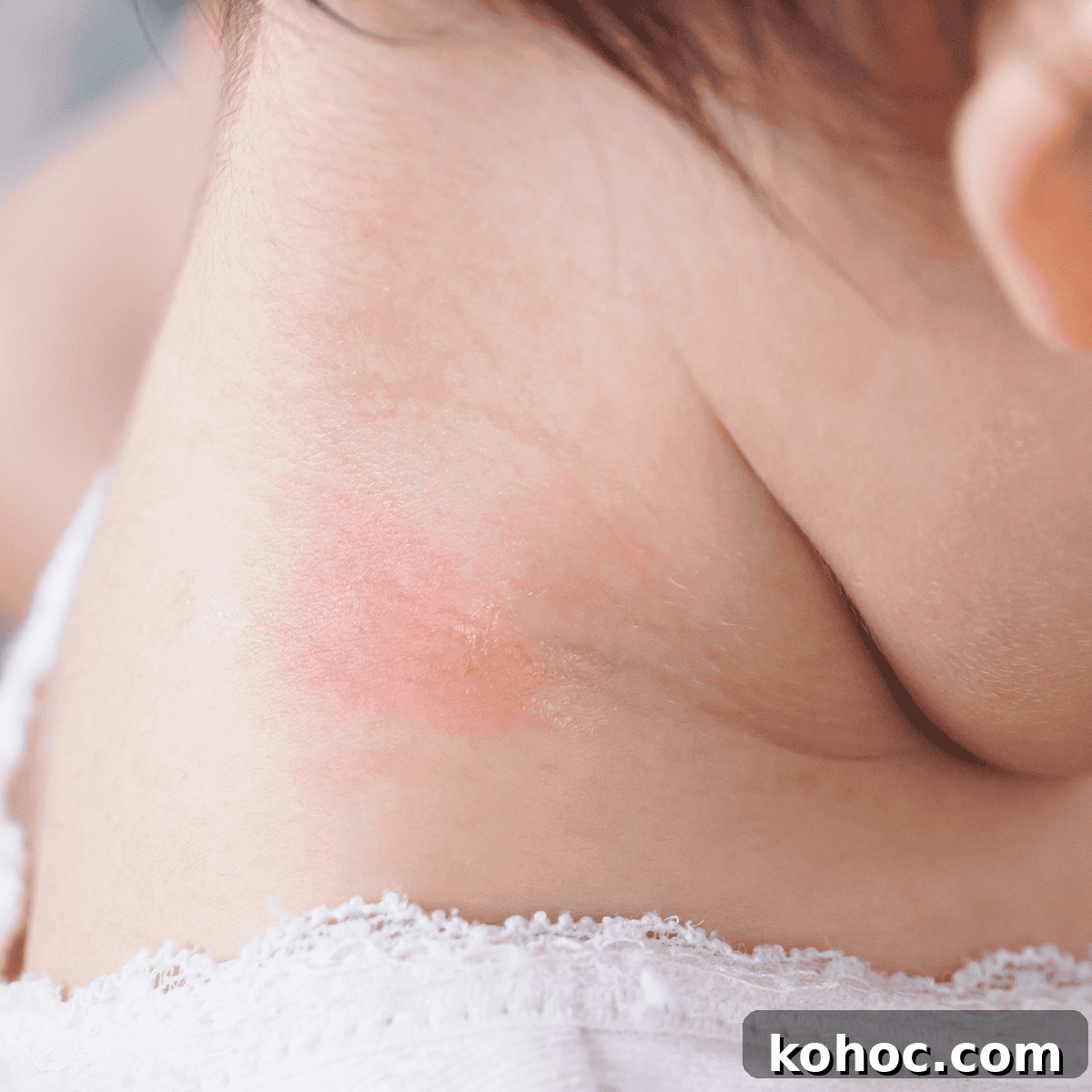 rash on baby's neck